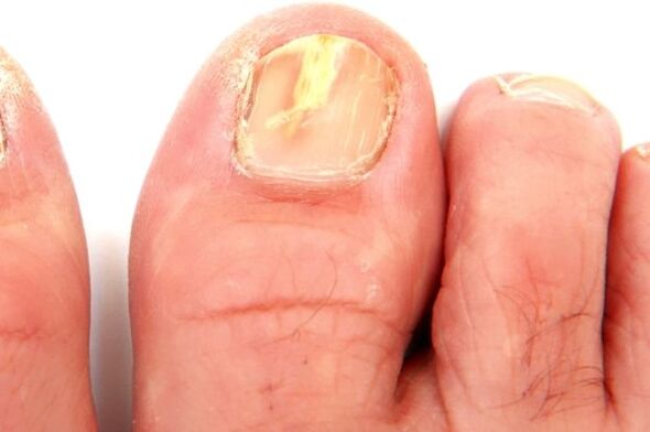 poškození nehtové ploténky v důsledku houbové infekce